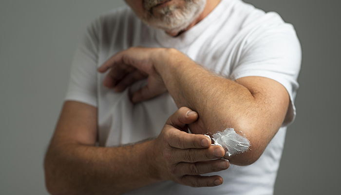 ¿Picaduras de mosquitos o medusas? Alivia el picor al instante